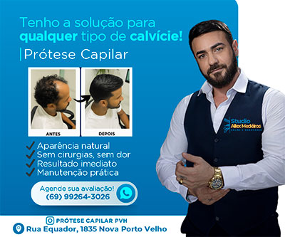 PROTESE CAPILAR